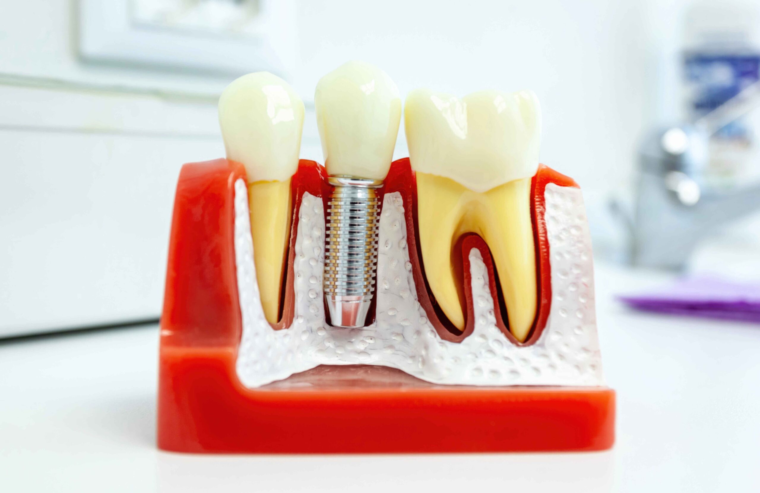 elfbar nachfüll pod läuft aus Quels sont les effets de la cigarette sur les dents et sur les implants  dentaires ? main image 1