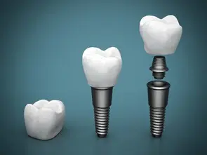 Dental Implants From Titanium Implant to Crown Installed