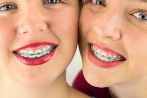 Orthodontic Dentist in Pico Rivera Braces on Patients