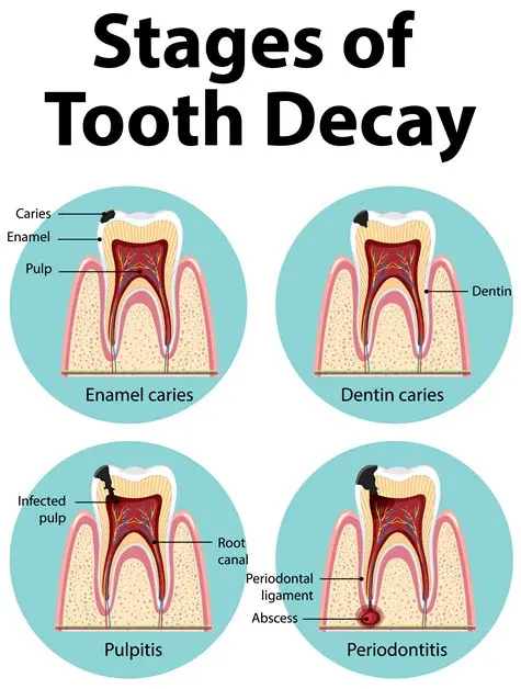 imgi_7_Stages-of-Tooth-Decay