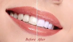 Teeth Whitening in Pico Rivera By Cosmetic Dentist